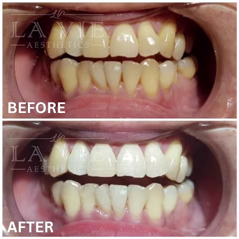 Best Teeth Whitening Treatment Promotion