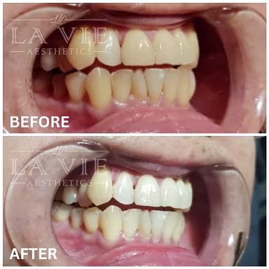 Best Teeth Whitening Treatment Promotion